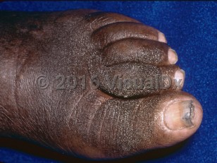 Clinical image of Podoconiosis - imageId=6889729. Click to open in gallery.  caption: 'Myriads of keratotic excrescences arising in edematous toes and similar findings on the dorsal foot.'