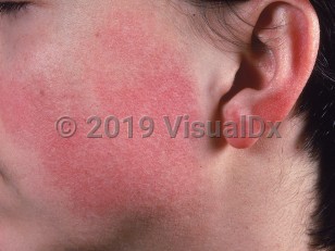 Clinical image of Keratosis pilaris atrophicans faciei - imageId=692642. Click to open in gallery.  caption: 'Marked erythema of the cheek and ear with follicular prominence on the cheek.'