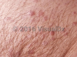 Clinical image of Non-Hodgkin lymphoma - imageId=69370. Click to open in gallery.  caption: 'A close-up of numerous smooth, dull, pink papules.'