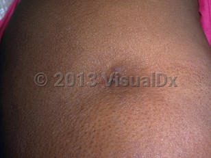 Clinical image of Lupus panniculitis - imageId=6964223. Click to open in gallery.  caption: 'A depressed, erythematous plaque with central scale on the arm.'