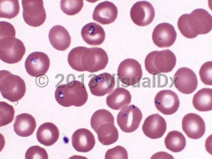 Lab image of Babesiosis - imageId=6968796. Click to open in gallery.  caption: '<span>Blood smear showing various intraerythrocytic forms of babesia.</span>'