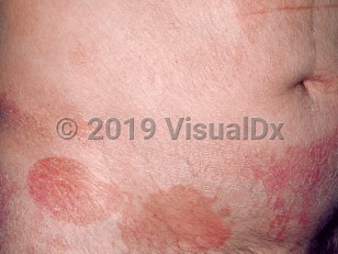 Clinical image of Cutaneous T-cell lymphoma