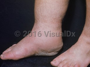 Clinical image of Congenital lymphedema