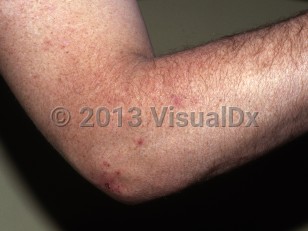 Clinical image of Brachioradial pruritus - imageId=7058582. Click to open in gallery.  caption: 'Crusted papules on the forearm near the elbow.'
