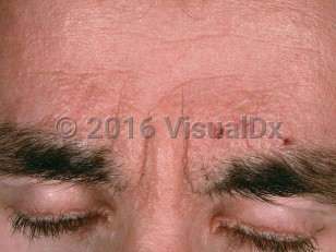 Clinical image of Lipoid proteinosis - imageId=706559. Click to open in gallery.  caption: 'Smooth, shiny, coalescing, yellowish papules, forming plaques, on the lower forehead and glabella. Note also the confluent papules along the eyelid margin.'