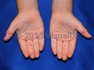 Clinical image of Fibroblastic rheumatism - imageId=7086531. Click to open in gallery.  caption: 'Smooth pink papules of varying sizes on the fingers and thumbs.'
