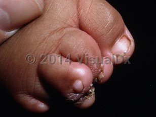 Clinical image of Pseudoainhum - imageId=7139648. Click to open in gallery.  caption: 'Crusted constriction bands on the toes.'