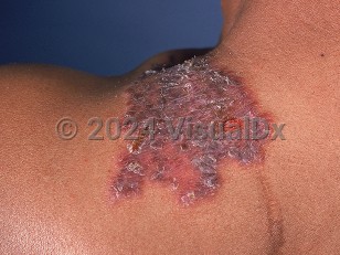 Clinical image of Cutaneous tuberculosis