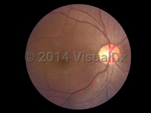 Clinical image of Macular pucker - imageId=7171019. Click to open in gallery. 