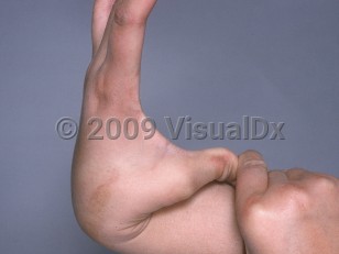 Clinical image of Marfan syndrome - imageId=721737. Click to open in gallery.  caption: 'A hyperextensible thumb.'