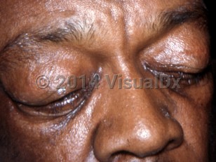 Clinical image of Obesity hypoventilation syndrome - imageId=7225731. Click to open in gallery.  caption: 'Periorbital edema. '