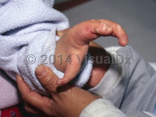 Clinical image of Cornelia de Lange syndrome - imageId=7269554. Click to open in gallery.  caption: 'Missing digits, a proximally positioned thumb, and a rudimentary hand.'