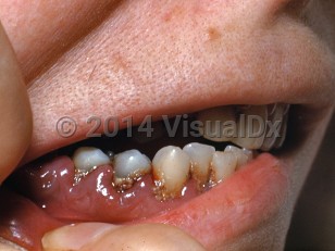 Clinical image of Acute myeloid leukemia - imageId=7275584. Click to open in gallery.  caption: 'Gingival hypertrophy and dental plaque around tooth margins.'