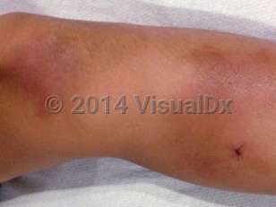 Clinical image of Hyperimmunoglobulinemia D syndrome - imageId=7279310. Click to open in gallery.  caption: 'Erythematous and brownish nodules and plaques on the leg that were tender to palpation.'