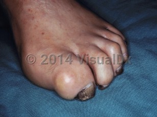 Clinical image of Charcot-Marie-Tooth disease - imageId=7298164. Click to open in gallery. 