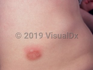 Clinical image of Mastocytoma - imageId=729955. Click to open in gallery.  caption: 'An edematous pink plaque with a peau d'orange appearance on the flank.'