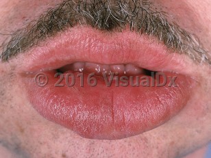 Clinical image of Melkersson-Rosenthal syndrome - imageId=730112. Click to open in gallery.  caption: 'Massive edema of the lower lip and gingival hypertrophy.'