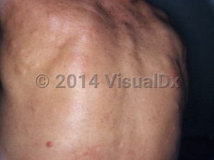 Clinical image of Familial cutaneous collagenoma syndrome