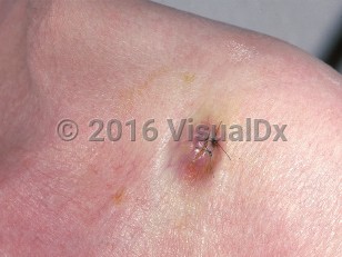Clinical image of Metastatic adenocarcinoma - imageId=730810. Click to open in gallery.  caption: 'A violaceous nodule near the shoulder (metastatic colon carcinoma).'