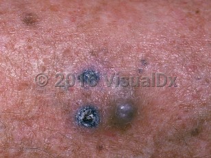 Clinical image of Metastatic cutaneous melanoma