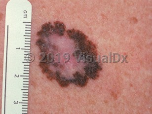 Clinical image of Melanoma - imageId=732728. Click to open in gallery.  caption: 'A close-up of a large variegated plaque with pink, dark brown, and rust colors. Note also irregular borders and asymmetry.'