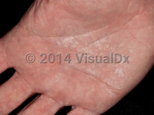 Clinical image of Aquagenic wrinkling of the palms