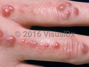 Clinical image of Multicentric reticulohistiocytosis - imageId=737762. Click to open in gallery.  caption: 'Numerous smooth, red and maroon papules on the dorsal fingers.'