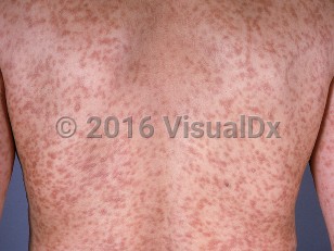 Clinical image of Mastocytosis in adults - imageId=739466. Click to open in gallery.  caption: 'A myriad of light brown and reddish macules and thin papules, some discrete and some confluent, on the back and arms.'