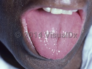 Clinical image of Vitamin B2 deficiency - imageId=7395462. Click to open in gallery. 