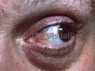 Clinical image of Ochronosis - imageId=7396661. Click to open in gallery.  caption: 'A faint blue discoloration of the sclera.'
