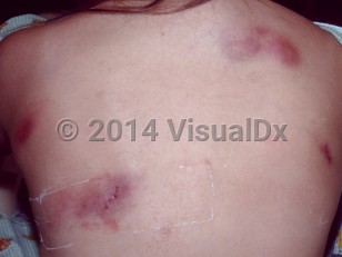 Clinical image of Alpha-1 antitrypsin deficiency - imageId=7397923. Click to open in gallery.  caption: 'Panniculitis'