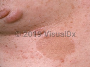 Clinical image of Neurofibromatosis - imageId=742400. Click to open in gallery.  caption: 'A close-up of pinkish and brownish papules and nodules (neurofibromas) and light brown patches (confetti and <span>café au lait </span> macules).'
