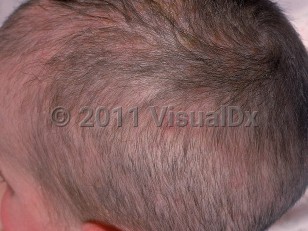 Clinical image of Netherton syndrome - imageId=748544. Click to open in gallery.  caption: 'Sparse, short, broken-off hairs and background erythema of the scalp.'