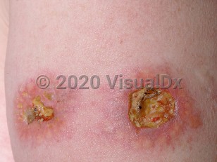 Clinical image of Necrobiotic xanthogranuloma