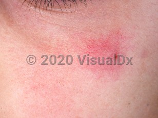 Clinical image of Spider angioma - imageId=749347. Click to open in gallery.  caption: 'A close-up of a tiny, bright red papule with numerous radiating telangiectasias and pink erythema on the cheek.'