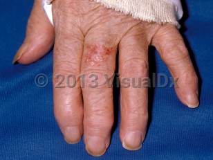 Clinical image of Squamous cell carcinoma in situ - imageId=75121. Click to open in gallery.  caption: 'A well-demarcated, scaly, erythematous plaque on the dorsal finger.'