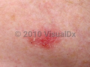 Clinical image of Superficial basal cell carcinoma