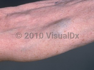 Clinical image of Blue rubber bleb nevus syndrome - imageId=752270. Click to open in gallery.  caption: 'A bluish nodule on the forearm.'