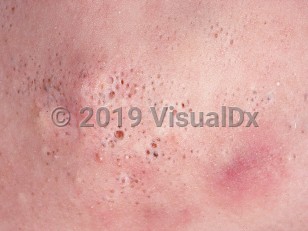 Clinical image of Nevus comedonicus - imageId=753599. Click to open in gallery.  caption: 'A close-up of groups of comedone-like pits of varying sizes and some tiny white papules.'