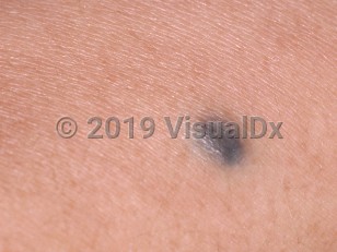 Clinical image of Blue nevus