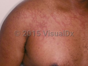Clinical image of Parvovirus B19 infection - imageId=7602433. Click to open in gallery.  caption: 'Widespread deep pink, lacy plaques on the upper trunk and arm.<br/><br/>Image appears with permission from East Carolina University Division of Dermatology.'