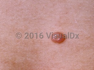 Clinical image of Molluscum contagiosum (pediatric) - imageId=76426. Click to open in gallery.  caption: 'A close-up of a pink umbilicated papule.'