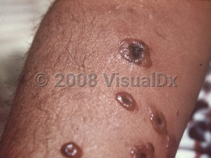 Clinical image of Cutaneous anthrax - imageId=765248. Click to open in gallery.  caption: 'Numerous bullae with central umbilication, some with early eschar formation, on the arm.'