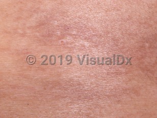 Clinical image of Hereditary coproporphyria - imageId=765887. Click to open in gallery. 