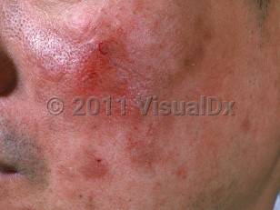 Clinical image of Pemphigus erythematosus - imageId=765968. Click to open in gallery.  caption: 'Eroded plaques and surrounding post-inflammatory hyperpigmentation on the cheek.'