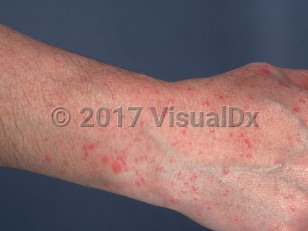 Clinical image of Polymorphous light eruption - imageId=766208. Click to open in gallery.  caption: 'Multiple erythematous papules and papulovesicles on the dorsal hand and forearm.'