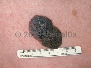 Clinical image of Seborrheic keratosis - imageId=76731. Click to open in gallery.  caption: 'An inflamed seborrheic keratosis showing a substantive pink and gray, stuck-on, verrucous plaque with keratotic plugs on the surface.'