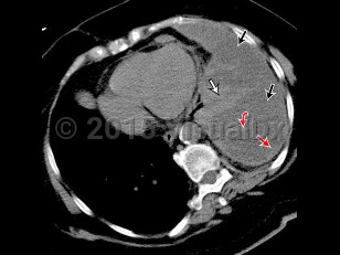 Imaging Studies image of Pleural effusion - imageId=7677012. Click to open in gallery.  caption: '<span>67 year old female with metastatic non-small-cell lung adenocarcinoma who presented with recurrent pleural effusions requiring multiple therapeutic thoracenteses, and eventually a long-term tunneled catheter prior to hospice. Sequential axial non-contrast CT image of the chest viewed in soft-tissue windows through the lower chest. Sequential CT images obtained during placement of a left pleural drainage catheter show loculated fluid of near-water attenuation within the posterior, lateral, and anterior pleural spaces (straight black arrows), with resultant atelectatic/collapsed lung (straight white arrow). Note the thickened parietal pleura (straight red arrow), and the presence of fibrous bands (curved red arrow). A guidance needle approaches the left lateral inferior pleural space and is replaced by a pigtail catheter. Not unexpected is a small amount of air within the pleural space following placement. TPA was instilled via the catheter the following day in an attempt to disrupt the loculations.</span>'