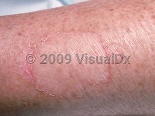 Clinical image of Porokeratosis (linear, Mibelli, plantar, ptychotropica) - imageId=768088. Click to open in gallery.  caption: 'A close-up of porokeratosis of Mibelli showing thin, atrophic plaques, each with a peripheral thin ridge of scale.'