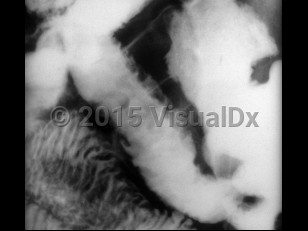 Imaging Studies image of Yersinia enterocolitica infection